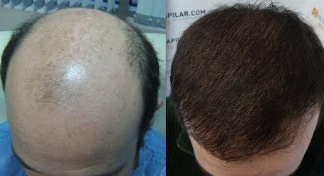 Before &After